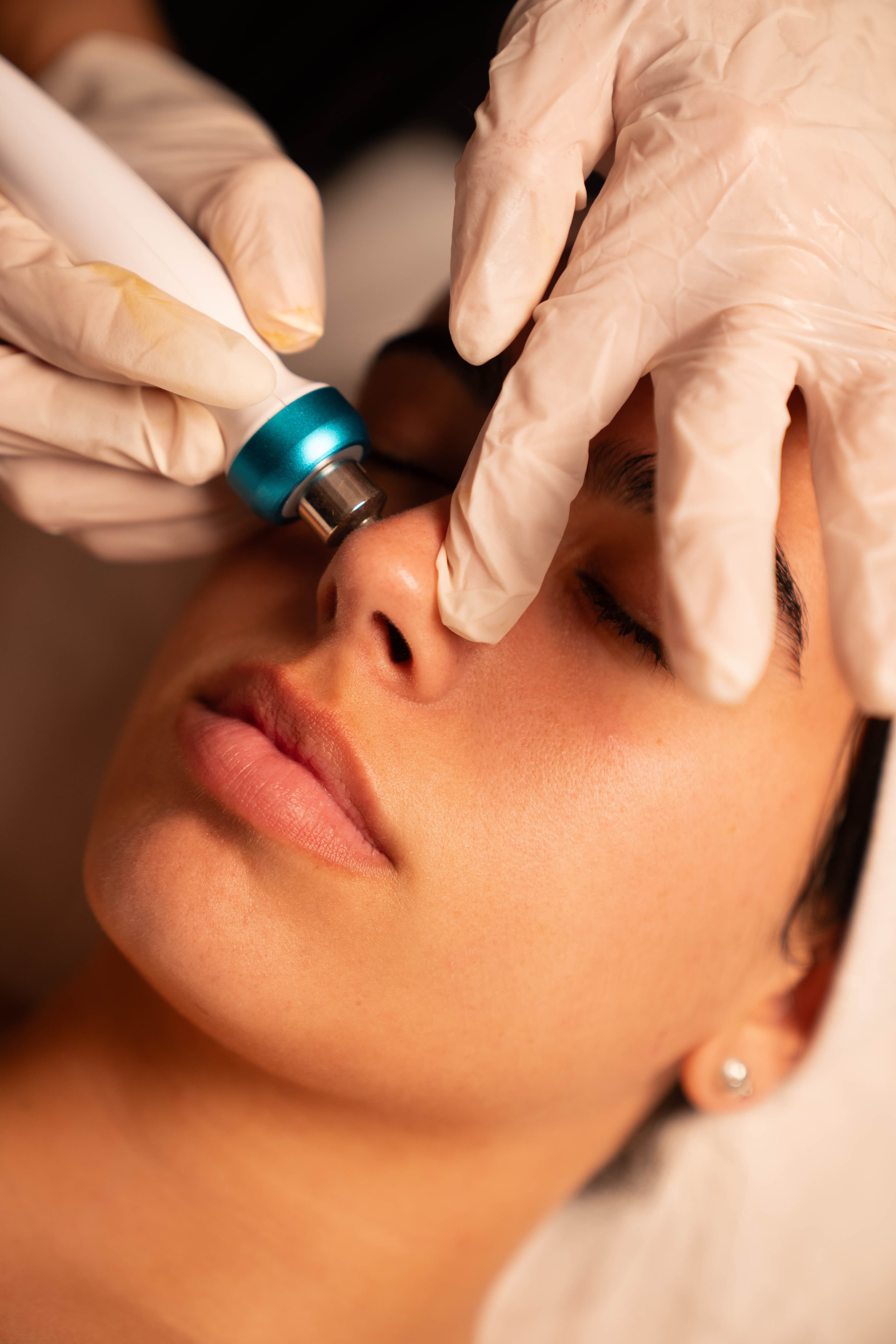 Tratamiento de microdermoabrasión facial